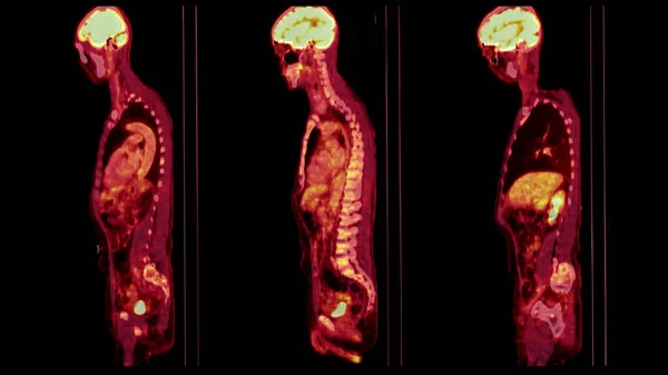 Pet Ctスキャン画像は ポジトロンのエミッショントモグラフィ Pet がん再発を発見するためのヘルプのための計算トモグラフィ を組み合わせた診断可視化です — ストック写真