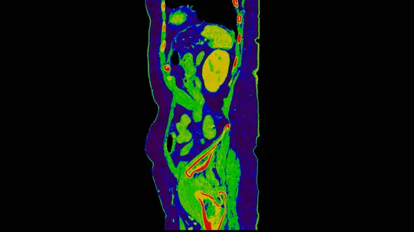腹部疾患の診断のための緑色モードのコロナビューの注入対照媒体が付いているアブドゥムのSegittalビューのCtスキャン — ストック写真