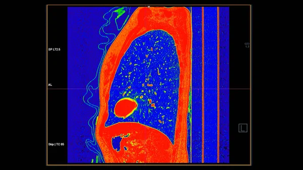 Tomografía Computarizada Vista Sagital Torácica Modo Color Para Diagnóstico Embolia — Foto de Stock