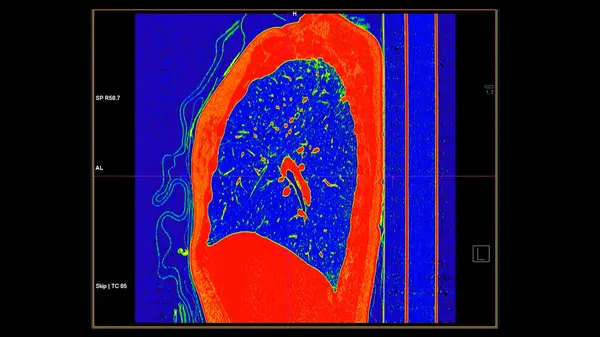 Pulmoner embolizma (PE), akciğer kanseri ve covid-19 için renk modunda göğüs sagital görüntüsünün CT taraması. 