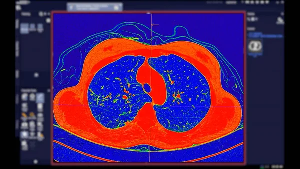 Tomografía Computarizada Tórax Vista Axial Modo Color Para Diagnóstico Embolia — Foto de Stock