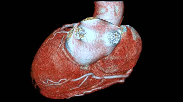 CTA coronary artery 3D rendering is a diagnostic imaging technique capturing detailed visuals of the heart\'s blood vessels in diagnosing coronary artery diseases and assessing cardiac health.