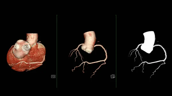 CTA coronary artery 3D rendering is a diagnostic imaging technique capturing detailed visuals of the heart\'s blood vessels in diagnosing coronary artery diseases and assessing cardiac health.