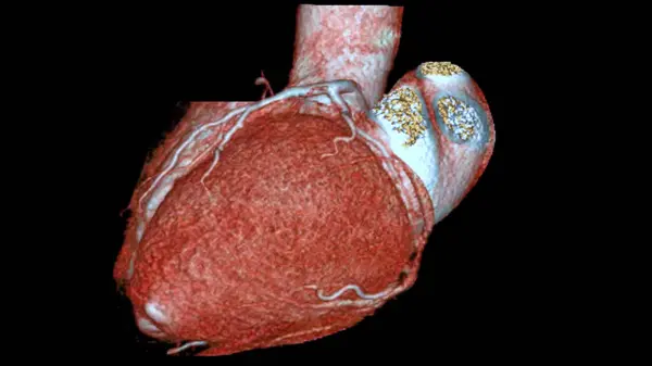 CTA coronary artery 3D rendering is a diagnostic imaging technique capturing detailed visuals of the heart's blood vessels in diagnosing coronary artery diseases and assessing cardiac health.