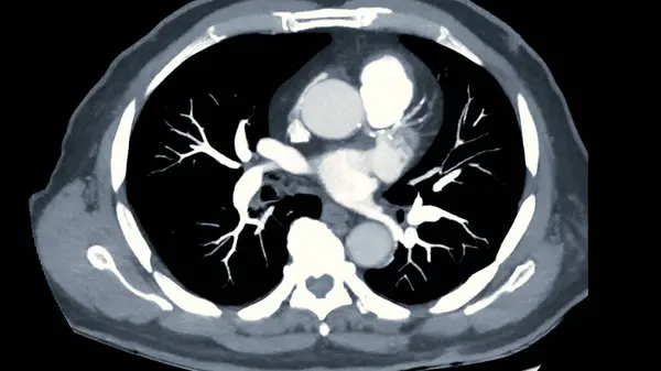 Ctpa Cta Pulmonary Artery Imaging Technique Offers Clear View Pulmonary — Stock Photo, Image
