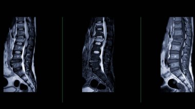 MRI L-S omurgası veya omurilik sıkışması tanısı için bel omurgası görüntüsü.