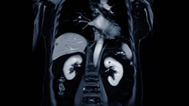 Karın üst koronal görüşün MRI 'sı karaciğer, pankreas ve böbrekler gibi organların detaylı görsellerini sağlayan invazif olmayan bir görüntüleme tekniğidir..