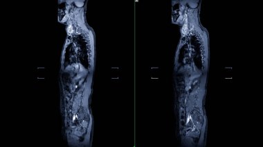 Tüm omurga görüntüsünün MR 'ı, tüm omurga yapısını detaylı bir şekilde anlamamızı sağlayan Manyetik Rezonans Görüntülemesi ile üretilen kapsamlı bir görsel temsildir..