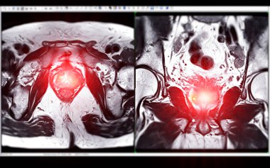 MRI of the prostate gland reveals Focal abnormal SI lesion at left PZpl at apex as described; PI-RADS category 4, clinicall clipart