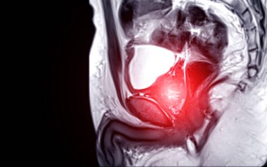 Prostat bezinin MRI 'ına göre sol PZpl' de Focal anormal SI lezyonu var; PI-RADS kategori 4, klinik