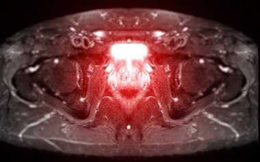 MRI of the prostate gland reveals Focal abnormal SI lesion at left PZpl at apex as described; PI-RADS category 4, clinicall clipart
