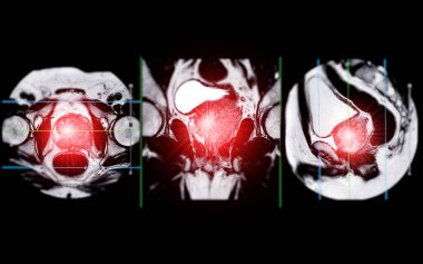 MRI of the prostate gland reveals a focal abnormal signal intensity (SI) lesion at the left posterolateral peripheral zones at the apex, aiding in diagnosing tumors and guiding treatment decisions. clipart