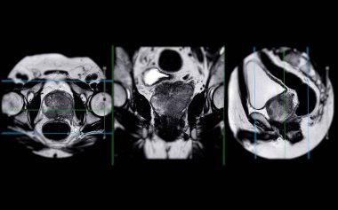 MRI of the prostate gland reveals a focal abnormal signal intensity (SI) lesion at the left posterolateral peripheral zones at the apex, aiding in diagnosing tumors and guiding treatment decisions. clipart