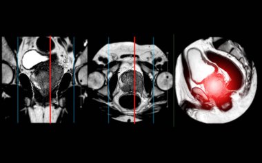 Prostat bezinin MR 'ı, apeksin sol posterolateral periferik bölgesinde tümörlerin teşhisine ve tedavi kararlarına yardımcı olan odaksal anormal sinyal yoğunluğu (SI) tespit etti..