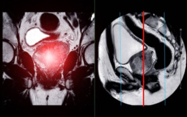 Prostat bezinin MR 'ı, apeksin sol posterolateral periferik bölgesinde tümörlerin teşhisine ve tedavi kararlarına yardımcı olan odaksal anormal sinyal yoğunluğu (SI) tespit etti..