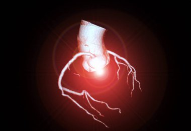CTA koroner arter 3D işleme, kalp damarlarının koroner arter hastalıklarının teşhisinde ve kalp sağlığı değerlendirmesinde detaylı görüntüleme tekniğidir..