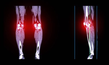 A CT venogram of the leg is a non-invasive imaging procedure offering detailed visuals of leg veins. clipart