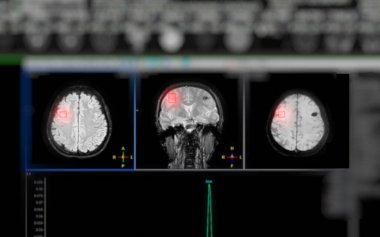 Felç hastalıklarında MR spektroskopisi yardımcı olur, etkilenen beyin dokularındaki metabolik değişiklikleri anlamak için anlayışlı kimyasal analizler sağlar..