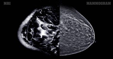 Göğüs MR 'ı kadınlarda BI-RADS 4' ü gösteriyor. Şüpheli bulgular gösteriyor. Kanserli lezyonların varlığını doğrulamak için olası kötü niyet ve biyopsi araştırmaları başlatılıyor..