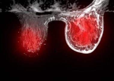 Göğüs MR 'ı kadınlarda BI-RADS 4' ü gösteriyor. Şüpheli bulgular gösteriyor. Kanserli lezyonların varlığını doğrulamak için olası kötü niyet ve biyopsi araştırmaları başlatılıyor..