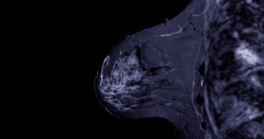 Breast MRI revealing BI-RADS 4 in women indicates suspicious findings warranting further investigation for potential malignancy and  biopsy to confirm the presence of cancerous lesions. clipart