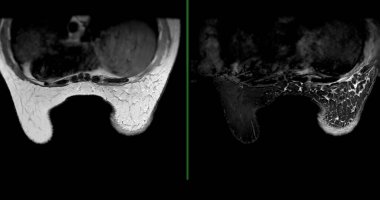 Göğüs MR 'ı kadınlarda BI-RADS 4' ü gösteriyor. Şüpheli bulgular gösteriyor. Kanserli lezyonların varlığını doğrulamak için olası kötü niyet ve biyopsi araştırmaları başlatılıyor..