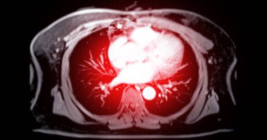 Karnın üst kısmının MR 'ı normal çalışma durumunda karaciğer, pankreas ve böbrek gibi organların detaylı görüntülerini sağlayan invazif olmayan bir görüntüleme tekniğidir..