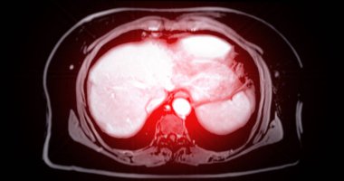Karnın üst kısmının MR 'ı normal çalışma durumunda karaciğer, pankreas ve böbrek gibi organların detaylı görüntülerini sağlayan invazif olmayan bir görüntüleme tekniğidir..