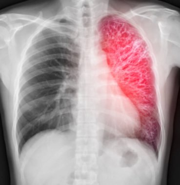 Chest X-ray Of Human Chest or Lung  fusion with CT scan 3D. clipart