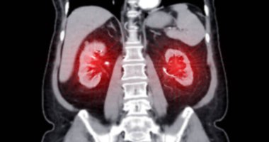  Karın tümünün tomografisi, koronal görünümde enjeksiyon kontrast ortamına sahip..