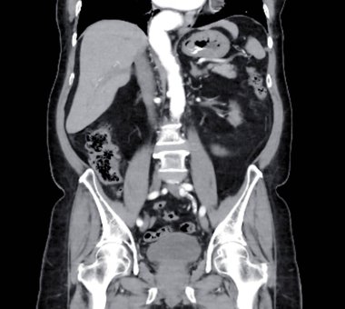  CT scan of  whole abdomen with injection contrast  media in coronal view. clipart