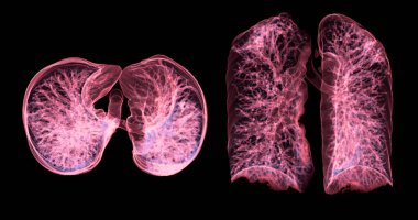 CT Chest or Lung 3d rendering image  showing Trachea and lung in respiratory system.	