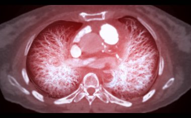 CT Chest or Lung 3d rendering image  showing Trachea and lung in respiratory system.	