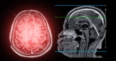 Beyin hastalıklarını tespit etmek için MRI beyin taraması sagittal düzlemi. Felç, beyin tümörleri ve enfeksiyonlar gibi..