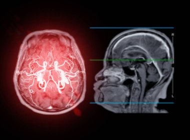 MRI  brain scan  sagittal plane for detect  Brain  diseases sush as stroke disease, Brain tumors and Infections. clipart