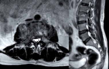 MRI L-S omurgası veya bel omurgası Axial ve sagittal T2 tekniği teşhis için referans hattı.