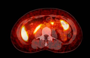 PET-CT tarama resmi, Pozitron Emisyon Tomografisi (PET) ve Bilgisayarlı Tomografi 'nin (CT) kanser yinelemesinin bulunmasına yardımcı olması için bir tanısal görselleştirmedir..