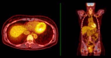 PET-CT tarama resmi, Pozitron Emisyon Tomografisi (PET) ve Bilgisayarlı Tomografi 'nin (CT) kanser yinelemesinin bulunmasına yardımcı olması için bir tanısal görselleştirmedir..