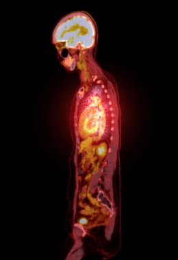 PET-CT tarama resmi, Pozitron Emisyon Tomografisi (PET) ve Bilgisayarlı Tomografi 'nin (CT) kanser yinelemesinin bulunmasına yardımcı olması için bir tanısal görselleştirmedir..