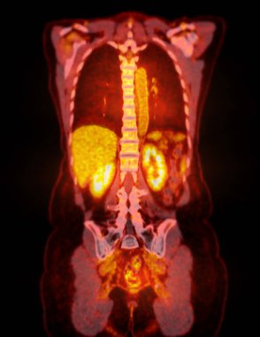 PET-CT tarama resmi, Pozitron Emisyon Tomografisi (PET) ve Bilgisayarlı Tomografi 'nin (CT) kanser yinelemesinin bulunmasına yardımcı olması için bir tanısal görselleştirmedir..