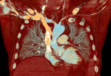 CTA torasik aort 3D işleme ayrıntılı görselleştirme sunarak, doğru tanı ve tedavi planlama için aort anatomisi, patoloji ve çevresindeki yapılar hakkında net görüşler sunar..