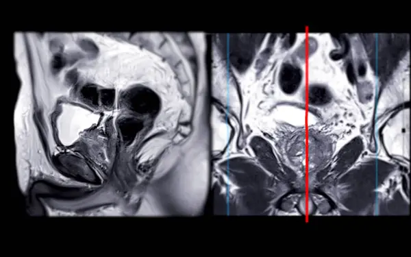 Stock image MRI of the prostate gland reveals Focal abnormal SI lesion at left PZpl at apex as described; PI-RADS category 4, clinicall