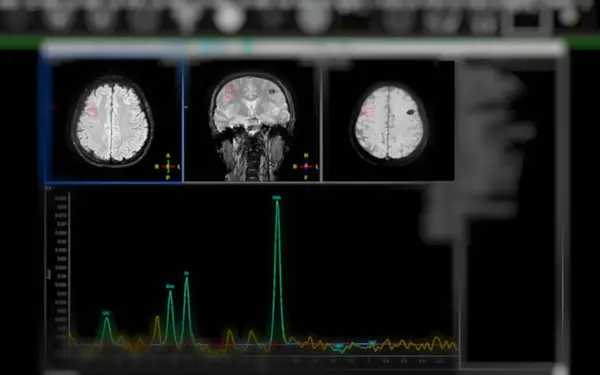 stock image MR spectroscopy aids in stroke diseases, providing insightful chemical analysis to understand metabolic changes in affected brain tissues.