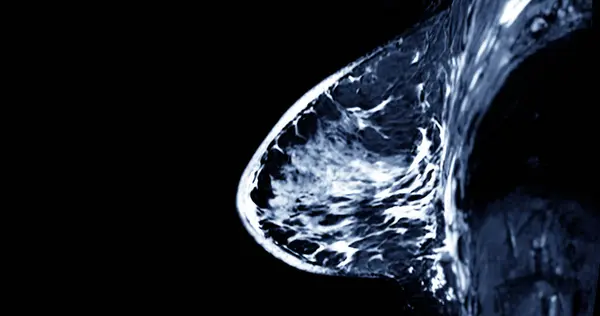 stock image Breast MRI revealing BI-RADS 4 in women indicates suspicious findings warranting further investigation for potential malignancy and  biopsy to confirm the presence of cancerous lesions.