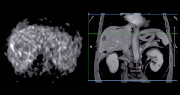 stock image PET MRI of the liver in liver cancer provides precise imaging, aiding in tumor detection, staging, and treatment planning.