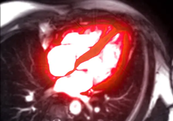 stock image Cardiac MRI evaluates heart health, providing detailed images for diagnosing cardiovascular conditions and planning treatment