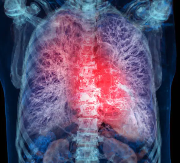 stock image CT Chest or Lung 3d rendering image  showing Trachea and lung in respiratory system.	