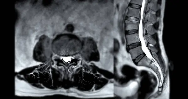 stock image MRI L-S spine or lumbar spine Axial and sagittal T2 technique with reference line  for diagnosis spinal cord compression.