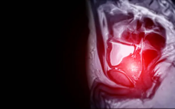 Mri Prostate Gland Reveals Focal Abnormal Lesion Left Pzpl Apex Stock Photo