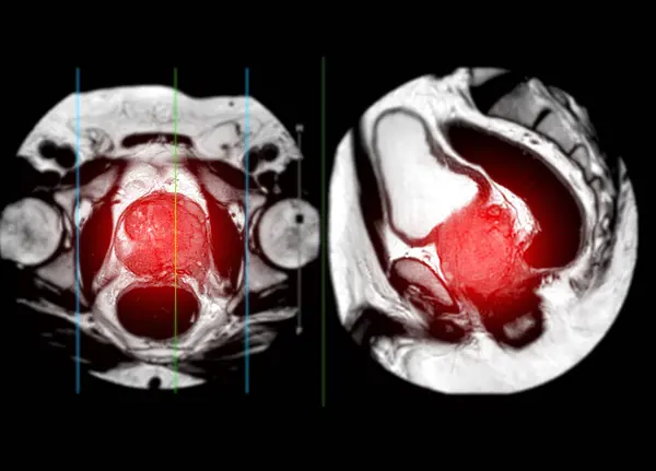 Mri Prostate Gland Reveals Focal Abnormal Signal Intensity Lesion Left Stock Image